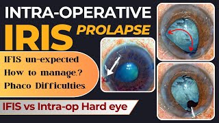 Intraop Iris Prolapse  IFIS unexpected How to manage Phaco Difficulties  Dr Deepak Megur [upl. by Haggerty98]