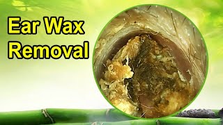 Best relaxing video earwax removal [upl. by Bigot]