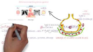 ARDS acute respiratory distress syndromeشرح [upl. by Remos]