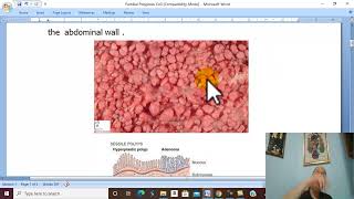 Intestinal Disorders in Arabic 11 Familial Polyposis Coli   by Dr Wahdan [upl. by Opiak]