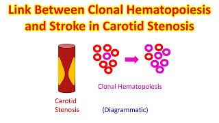 Link Between Clonal Hematopoiesis and Stroke in Carotid Stenosis [upl. by Yruama]