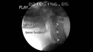 Zenkers diverticulum Barium Swallow [upl. by Efram]