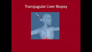 Transjugular Liver Biopsy [upl. by Gnauq]