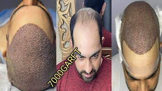 FUE Hair Transplant Timeline 1 Day to 10  After amp Before  Hair Transplant Results  Hair Care [upl. by Aidnama]