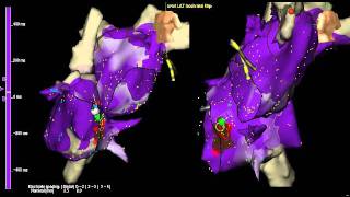 AV node reentry tachycardia atrial activation with 3D mapping [upl. by Yoho]