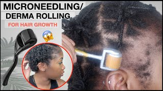 MICRONEEDLINGDERMA ROLLING FOR EDGE GROWTH  Two Month Update  TRACTION ALOPECIA 🚨 NO MINOXIDIL [upl. by Shafer]