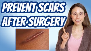 HOW TO PREVENT SCARS AFTER SURGERY 💉 DERMATOLOGIST DrDrayzday [upl. by Marketa]