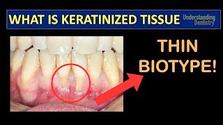 Gingival Recession Treatment How to Check the Keratinized Gingival Tissue Periodontal Maintenance [upl. by Asp]