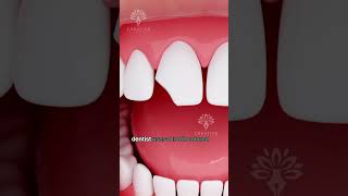 How Does Bonding Fix a Chipped Tooth shorts tooth  Creativelearning3d [upl. by Oirramed]