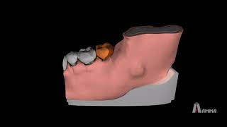 Animation  Dentigerous Cyst 3D Model [upl. by Lawan]