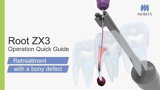 Root ZX3 Operation Quick Guide  Retreatment with a bony defect [upl. by Dorsy708]