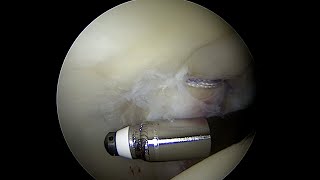 Articular Cartilage with a Grade 3 Injury to the Posterior Acetabulum near full thickness [upl. by Jariv653]