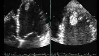 Dilated Cardiomyopathy with Mural Thrombus [upl. by Salter]