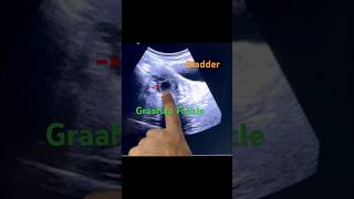 Graafian Follicle infertility pregnancyjourney ultrasound yt baby ytshorts short pcod yt [upl. by Ely]