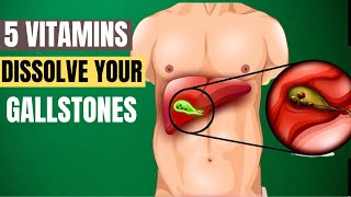 5 Vitamins To DISSOLVE Your GALLSTONES [upl. by Sikata]