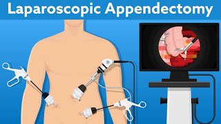 Laparoscopic  Appendix Removal Surgery  Appendectomy Instruments  Complications of Appendectomy [upl. by Doniv902]