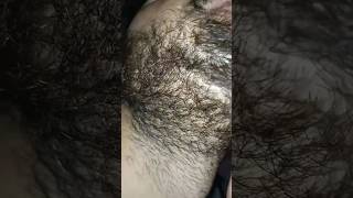 beard hair longer Carly problem beard hairproblem barber barbershop ingrownhair hairremoval [upl. by Cynthia986]