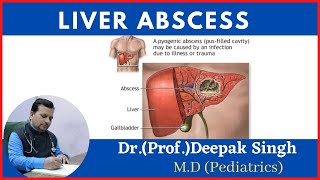 liver abscess  Hepatic abscess  Amoebic abscess  Deepak PD Singh [upl. by Attiuqahs]