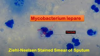 Sputum in ZiehlNeelsen in staining showing Mycobacterium leprae [upl. by Anirec]