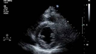 Hypokinesis Mitral Regurgitation Aortic Insufficiency [upl. by Yntirb]