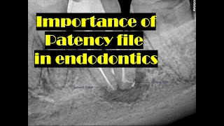 Importance of Patency file [upl. by Rainah]