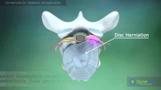 Thoracic Spondylosis Definition [upl. by Nitnilc]