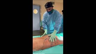 Lipotransferencia y Lipomodelacion gluteo [upl. by Nawrocki427]