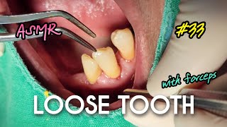 ASMR Loose Tooth Extraction [upl. by Refinej727]