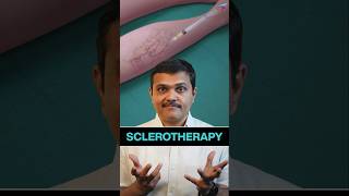 Varicose Vein REMOVAL by Injection shortvideos veinspecialist veins [upl. by Raina684]