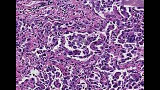 Histopathology LungDesquamative interstitial pneumonia [upl. by Durham]