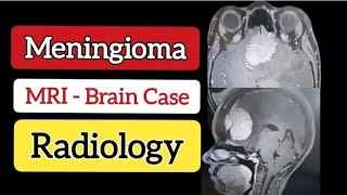 Meningioma  MRI Case Presentation with Answer amp Discussion  Radiology [upl. by Madoc]