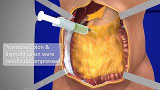 Exploratory Laparotomy  3D Medical Animation  Part  1  Films Blueray [upl. by Sathrum]