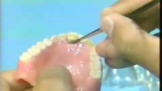 Replacing a Broken Complete Denture Tooth [upl. by Ansaev695]