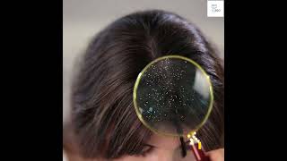 Dandruff Top 7 Natural Solutions [upl. by Aruasi]