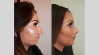 Rhinoplasty Review Selfie amp Testimonial [upl. by Ponce]