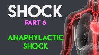 Anaphylactic Shock  Shock Part 6 [upl. by Euqinaj]