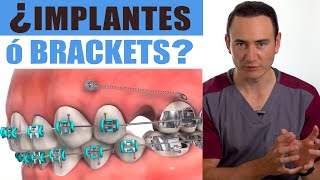 IMPLANTES o BRACKETS ¿Cuál va primero  ¡EL ORDEN SÍ IMPORTA  Ortodoncia vs Implantes [upl. by Woodcock]