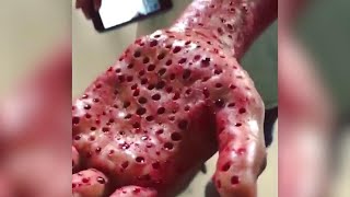 Do You Have Trypophobia The Fear of Holes  The Doctors [upl. by Caldwell]