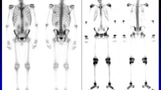 Essentials of Bone Scan  HD Basic Radiology [upl. by Noillid133]