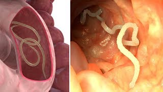 Natural Parasite Cleanse to get rid of intestinal worms [upl. by Reeva]