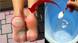 In Just 3 Minutes  Get Rid of CRACKED HEELS Permanently Magical Cracked Heels Home Remedy [upl. by Eigger]