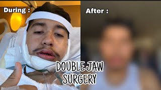 I got DOUBLE JAW surgery full experience [upl. by Sirred383]