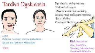 Tardive dyskinesia Causes Symptoms and Treatment [upl. by Ecnerolf]