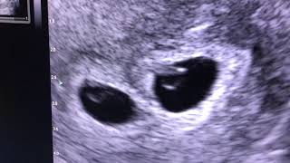 Sonogram Twins at 5 weeks [upl. by Samford]