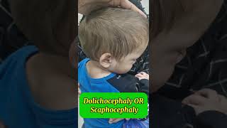 Dolichocephaly  Scaphocephaly Saggital craniosynostosis  abnormal head shape craniosynostosis [upl. by Edora]