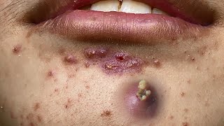 Big Cystic Acne Blackheads Extraction Blackheads amp Milia Whiteheads Removal Pimple Popping [upl. by Evans84]