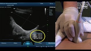 Hot Tip  Measuring Bladder Volume with Ultrasound [upl. by Eimmit]