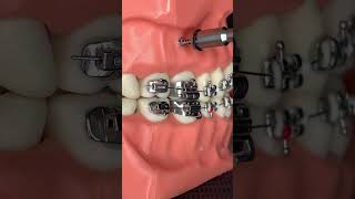 🔥Instalación de tornillos 🔩 en los BRACKETS 😬 SIN DOLOR 😫🔥 [upl. by Spiros]