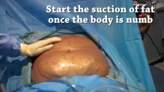 How is liposuction performed  Centre for Surgery [upl. by Streeto]