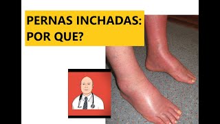 As 9 causas principais de pernas inchadas com sinais de alerta para ver o médico [upl. by Rastus472]